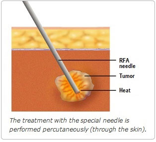 The treatment with the special needle is performed percutaneously (through the skin)